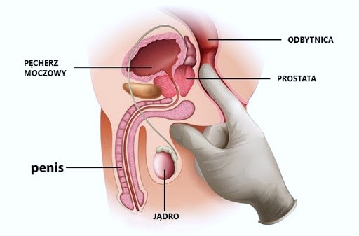 nowotwór prostaty czy należą się pieluchomajtki