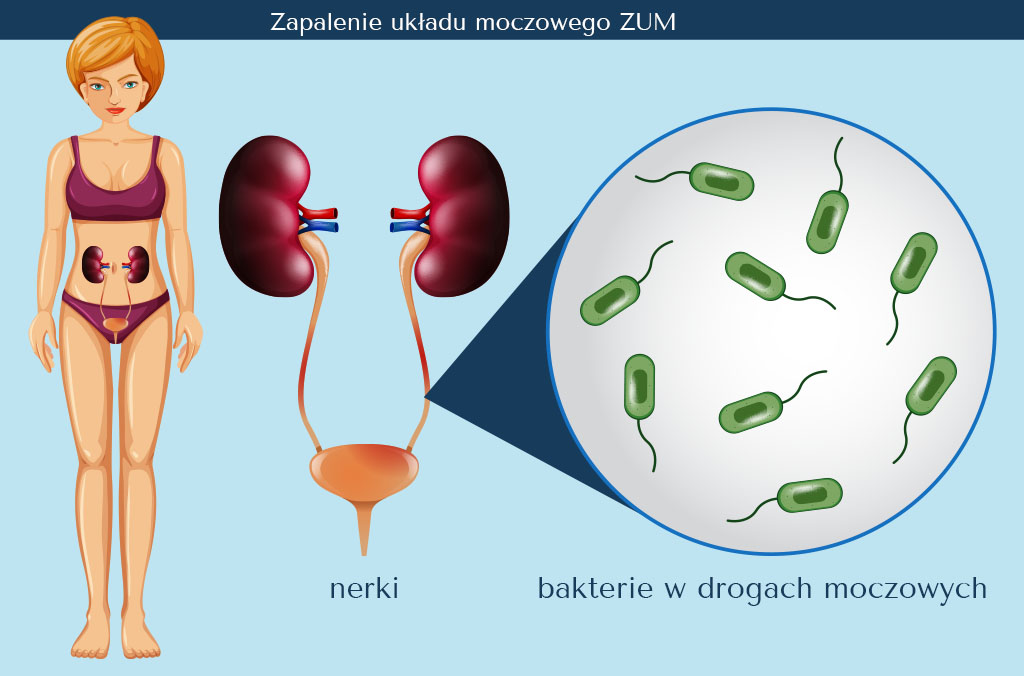 oduczanie pieluchy infekcja układu moczowego