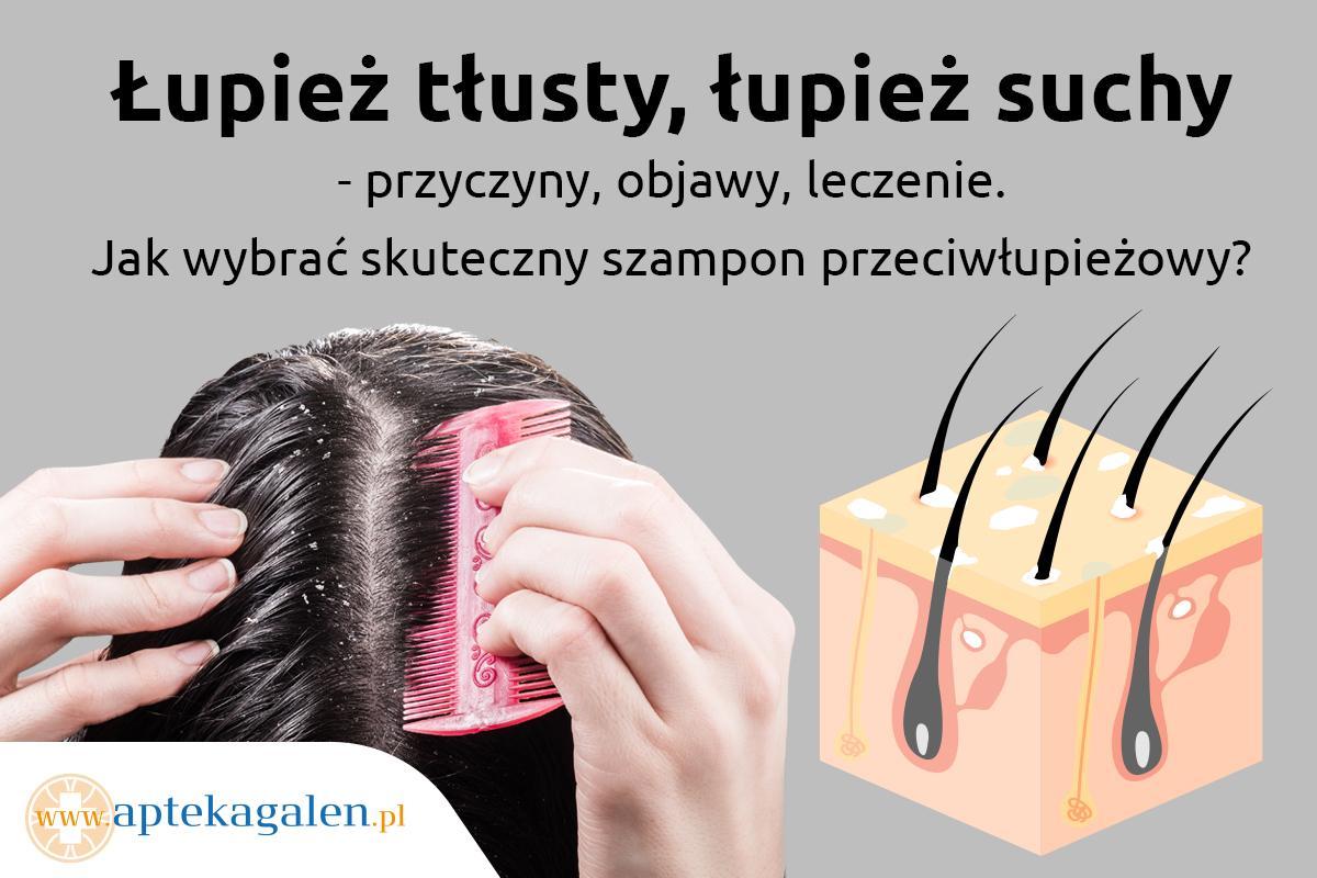 nie wiem czy lupiez czy zly szampon