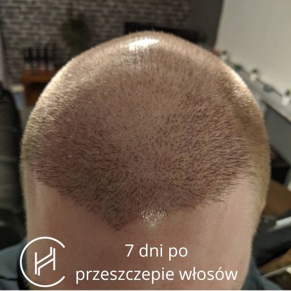 szampon przeciwłupieżowy ile dni po przeszczepie wlosow