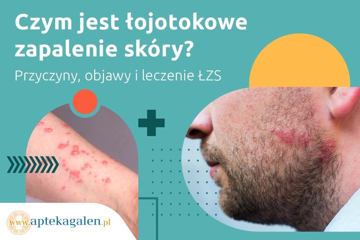 łojotokowe zapalenie skóry szampon eris