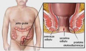 pieluchomajtki usunięcie odbytu